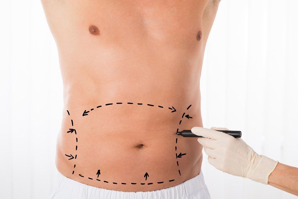 Tratamiento de cirugía plástica de abdomen y espalda